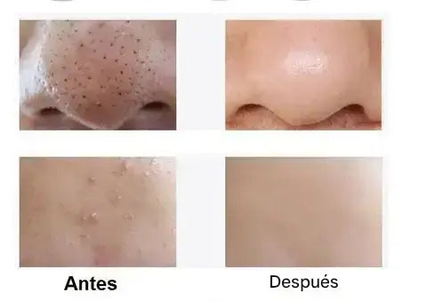 Removedor de Cravos Profissional a Vácuo – Pele Limpa