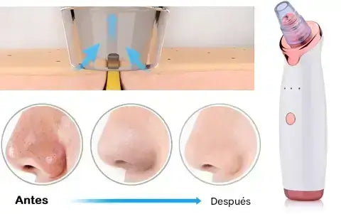 Removedor de Cravos Profissional a Vácuo – Pele Limpa