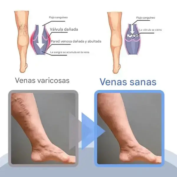 Spray Oveallgo™ para Venas Varicosas – Alivio y Belleza